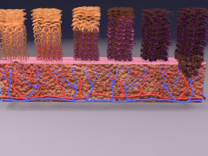 Cervical cancer dysplasia CIN Model 3D