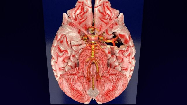 Cerebral aneurysms berry circle of willis Model 3D .c4d .max .obj .3ds .fbx .stl .blend 