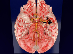 Cerebral aneurysms berry circle of willis 3D Model