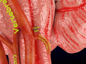 Cerebral aneurysms berry circle of willis Model 3D