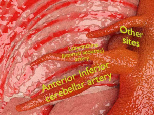 Cerebral aneurysms berry circle of willis Model 3D