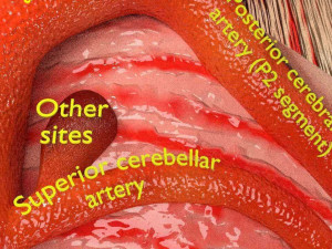 Cerebral aneurysms berry circle of willis Model 3D