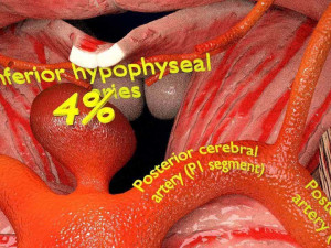 Cerebral aneurysms berry circle of willis Model 3D
