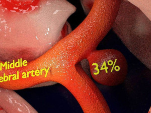 Cerebral aneurysms berry circle of willis Model 3D