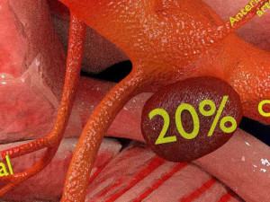 Cerebral aneurysms berry circle of willis Model 3D