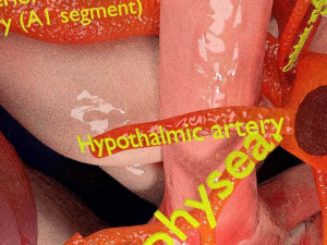 Cerebral aneurysms berry circle of willis Model 3D