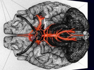 Cerebral aneurysms berry circle of willis Model 3D