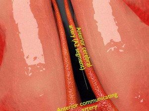 Circle of willis 3D 模型