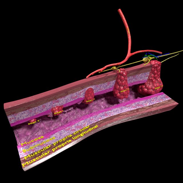 3D Colon cancer staging detail labelled 3D Model .c4d .max .obj .3ds .fbx .stl .blend 