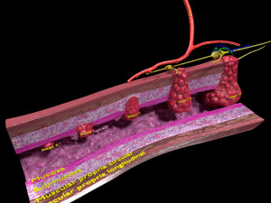 3D Colon cancer staging detail labelled 3D Model
