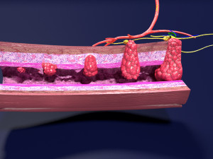 3D Colon cancer staging detail labelled 3D Model