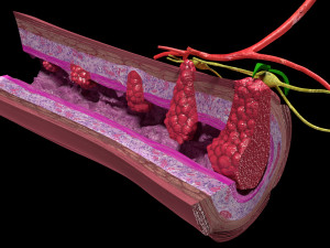 3D Colon cancer staging detail labelled 3D Model