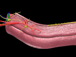 3D Colon cancer staging detail labelled 3D Model