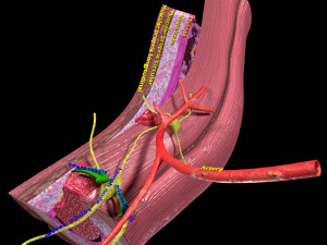3D Colon cancer staging detail labelled 3D Model