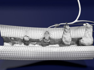 3D Colon cancer staging detail labelled 3D Model
