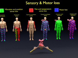 Spinal cord injuries and its various sensory and motor signs 3D Model