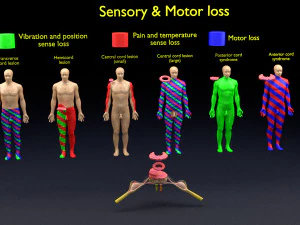 रीढ़ की हड्डी की चोटें और इसके विभिन्न संवेदी और मोटर संकेत 3D मॉडल
