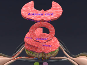 Spinal cord injuries and its various sensory and motor signs 3D Model