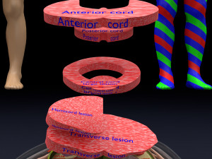 Spinal cord injuries and its various sensory and motor signs 3D Модель