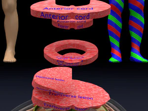 Spinal cord injuries and its various sensory and motor signs 3D Model