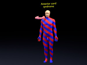 Spinal cord injuries and its various sensory and motor signs 3D Модель