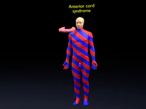 Spinal cord injuries and its various sensory and motor signs 3D Model