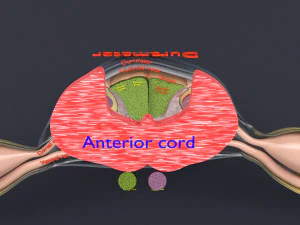 Spinal cord injuries and its various sensory and motor signs 3D Model