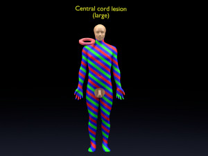 Spinal cord injuries and its various sensory and motor signs 3D Модель