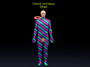 Spinal cord injuries and its various sensory and motor signs 3D Model