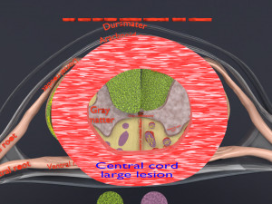 Spinal cord injuries and its various sensory and motor signs 3D Модель