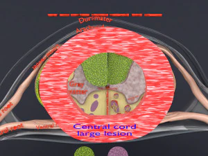 Spinal cord injuries and its various sensory and motor signs 3D Model