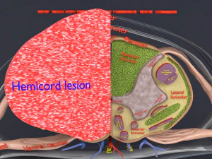 Spinal cord injuries and its various sensory and motor signs 3D Model