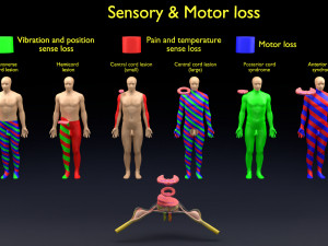 Spinal cord injuries and its various sensory and motor signs 3D Модель