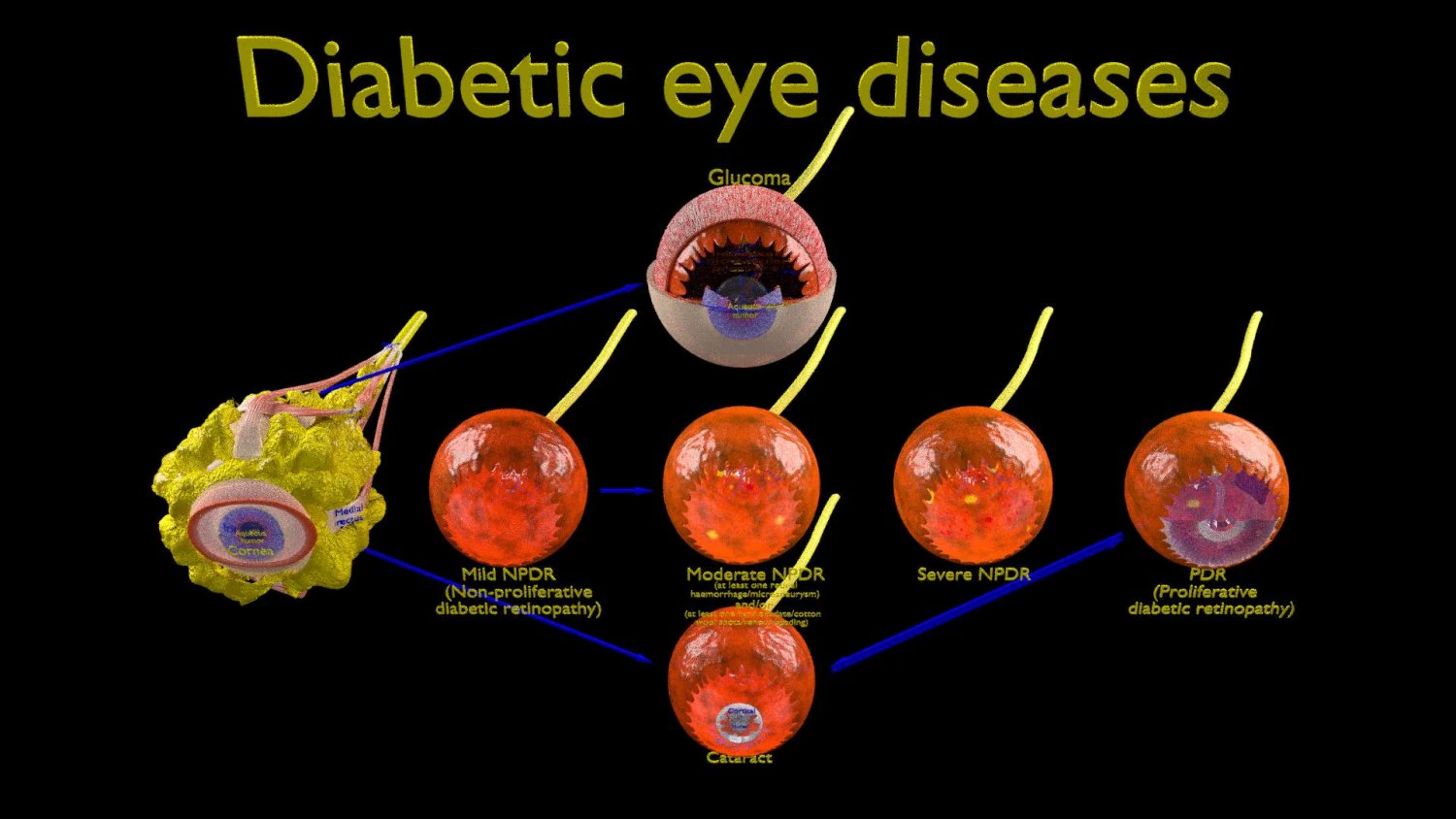 Diabetic eye diseases model 3D Model .c4d .max .obj .3ds .fbx .stl .blend