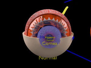 Diabetic eye diseases model 3D Model