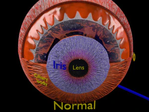 Diabetic eye diseases model 3D Model