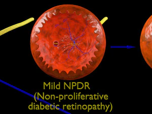 Diabetic eye diseases model 3D Model