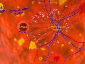 Diabetic eye diseases model 3D Model