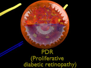 Diabetic eye diseases model 3D Model