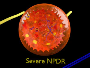 Diabetic eye diseases model 3D Model