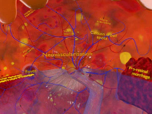 Diabetic eye diseases model 3D Model