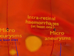 Diabetic eye diseases model 3Dモデル