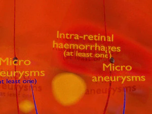 Diabetic eye diseases model 3D Model