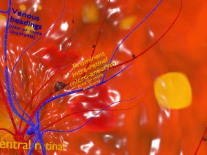 Diabetic eye diseases model 3D Model