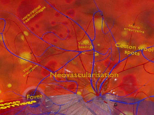 Diabetic eye diseases model 3D Model