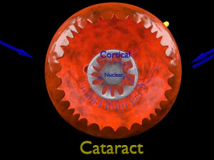 Diabetic eye diseases model 3D Model