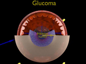 Diabetic eye diseases model 3D Model