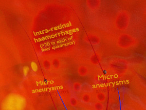 Diabetic eye diseases model 3Dモデル