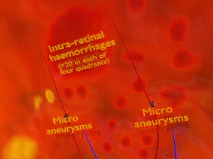 Diabetic eye diseases model 3D Model