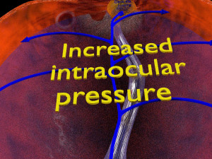 Diabetic eye diseases model 3Dモデル